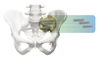 SI Joint Fusion